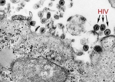 Investigadores desarrollan test de HTLV, un virus subdiagnosticado de la familia del HIV