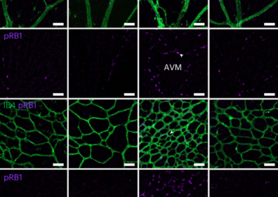 Researchers find key mechanism of rare vascular disease and test drugs