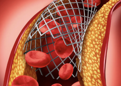 Colaboración regional aporta al desarrollo de material biodegradable para stents cardiovasculares